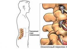 Position of a patient with a spinal fracture during transportation