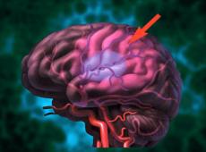 Vakava sairaus on aivoverisuoniiskemia, miten käsitellä sitä?